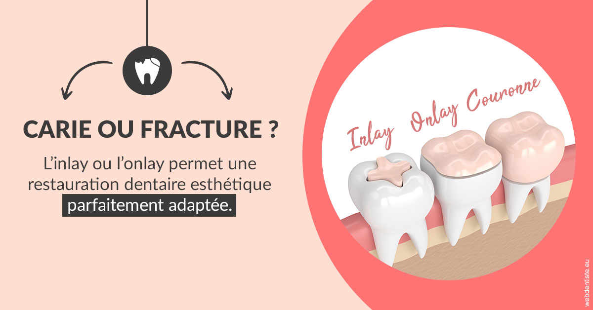 https://dr-thierry-guerin.chirurgiens-dentistes.fr/T2 2023 - Carie ou fracture 2