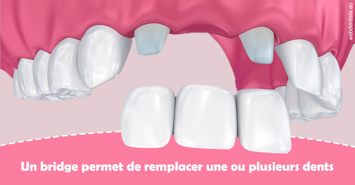 https://dr-thierry-guerin.chirurgiens-dentistes.fr/Bridge remplacer dents 2