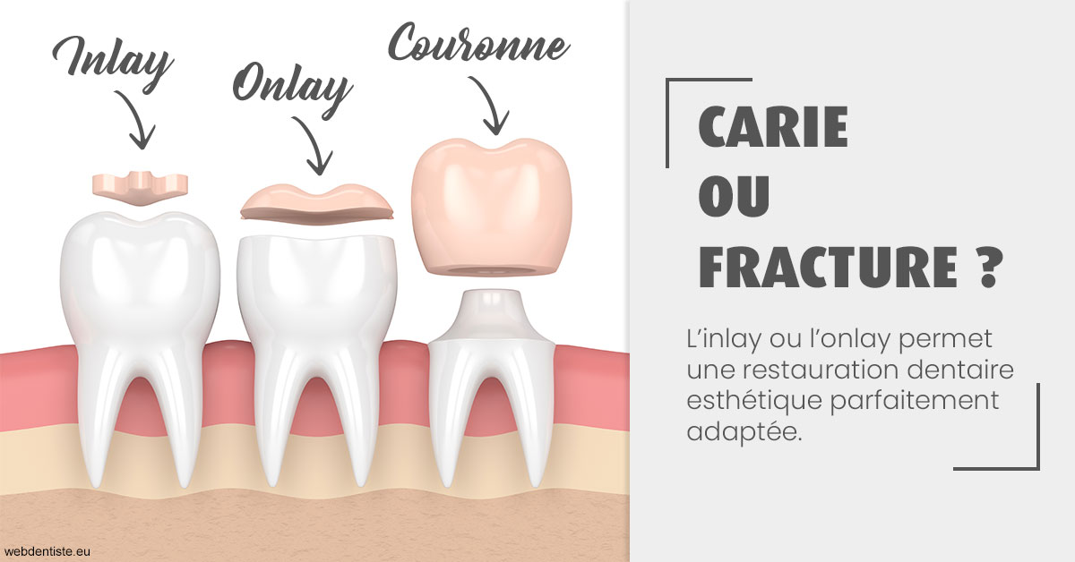https://dr-thierry-guerin.chirurgiens-dentistes.fr/T2 2023 - Carie ou fracture 1