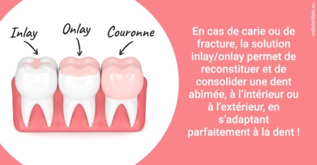 https://dr-thierry-guerin.chirurgiens-dentistes.fr/L'INLAY ou l'ONLAY 2