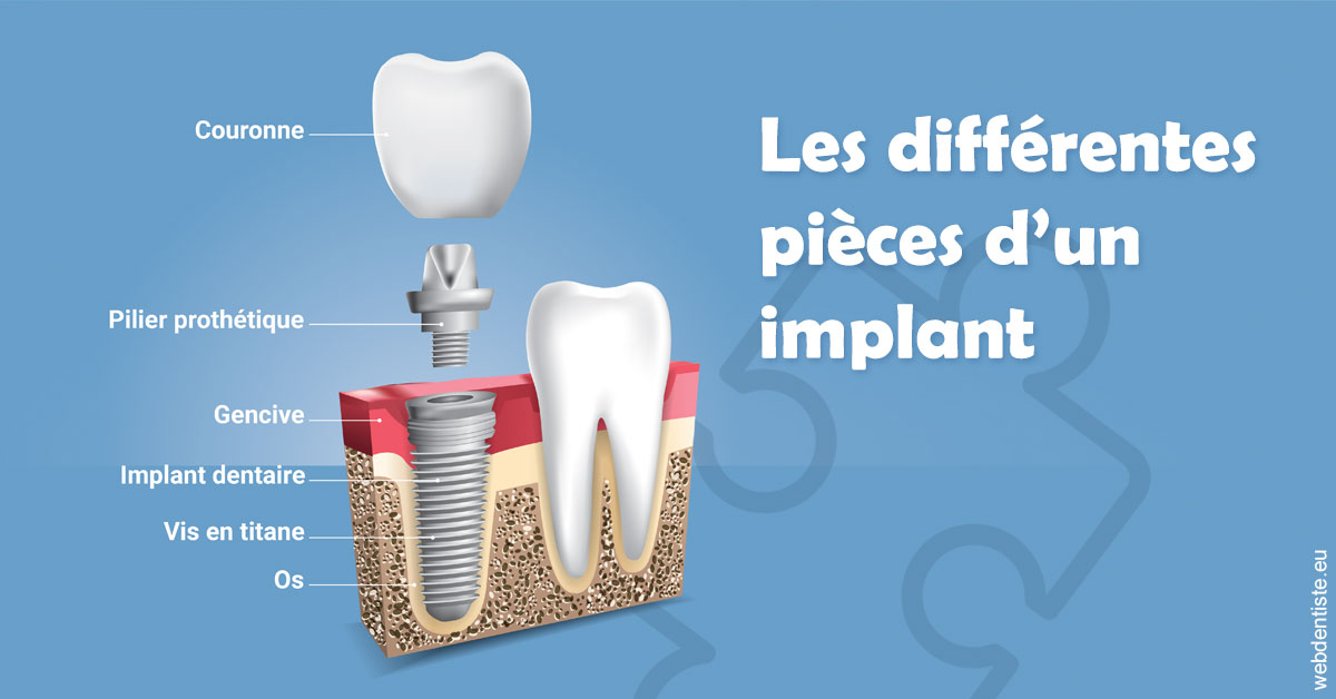 https://dr-thierry-guerin.chirurgiens-dentistes.fr/Les différentes pièces d’un implant 1